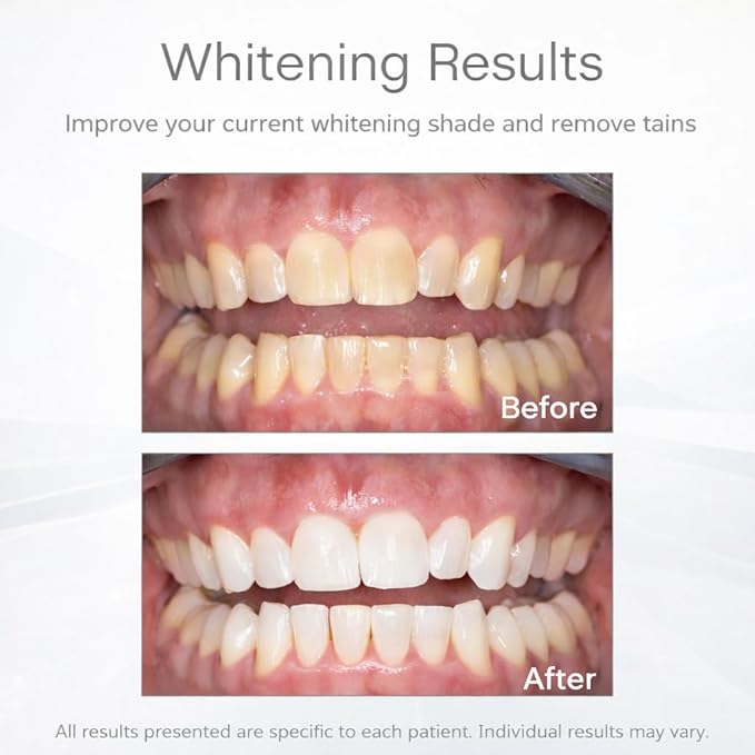 Opalescence Go™ 6% Prefilled Whitening Trays
